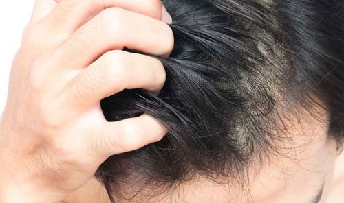 脱发严重是什么原因引起的(脱发严重是什么原因引起的女性16岁)